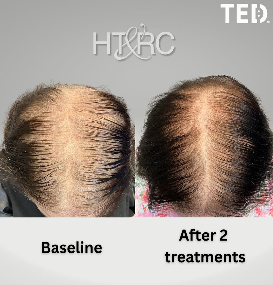 alma-ted-womens-non-surgical-treament-10 Alma TED Hair Restoration for Women at HT&RC