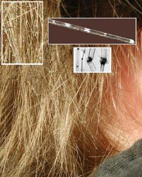 Excessive Hair Breakage: What You Need to Know