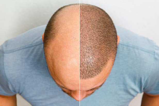 FUE Hair Transplant vs FUT Hair Transplant: Which is Better for You? Head of a balding man before and after hair transplant surgery