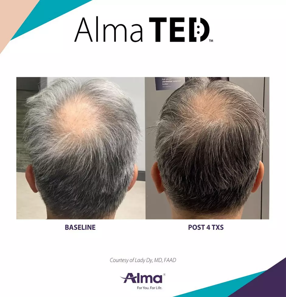alma ted mens non surgical treatment 4 alma ted mens non surgical treatment 4