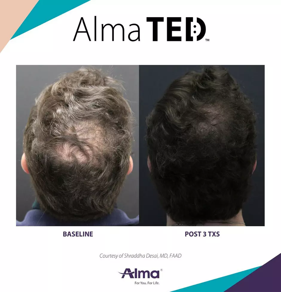 alma ted mens non surgical treatment 5 alma ted mens non surgical treatment 5