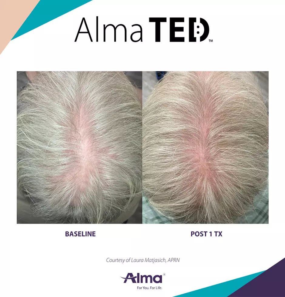 alma ted mens non surgical treatment 8 alma ted mens non surgical treatment 8
