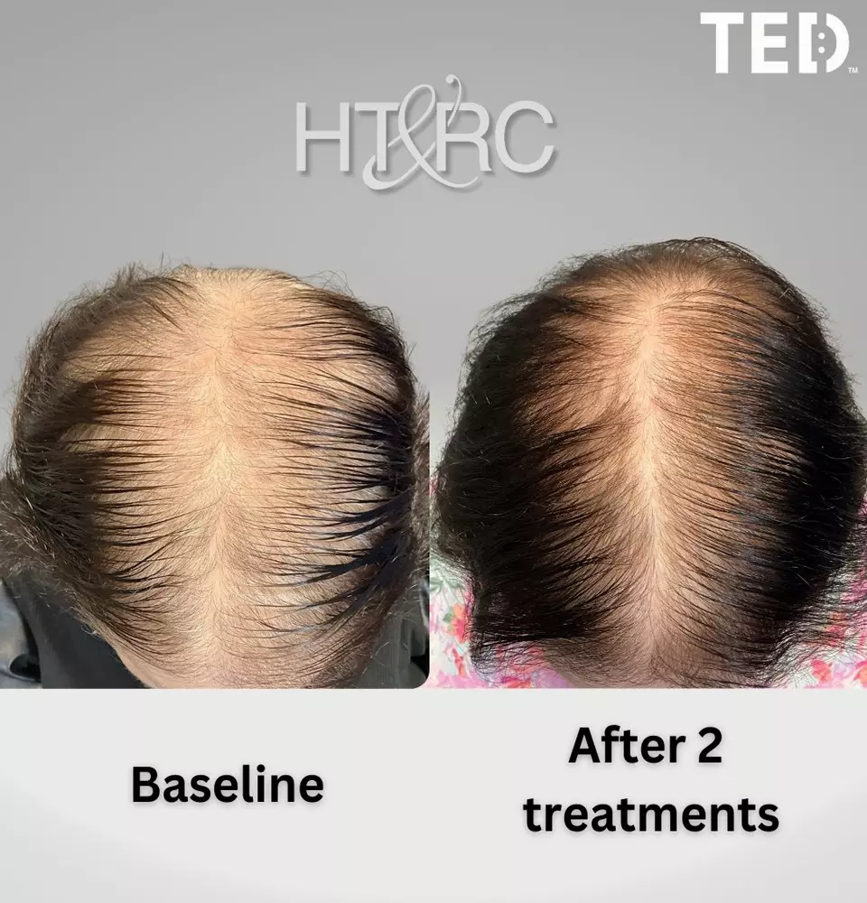alma ted womens non surgical treatment 3 alma-ted-womens-non-surgical-treament-10 Alma TED Hair Restoration for Women at HT&RC