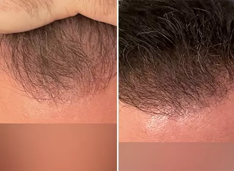 Hair Loss Patient 13