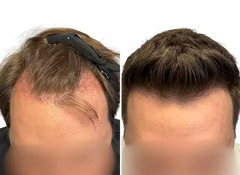 Hair Loss Patient 14 Hair Loss Patient 14