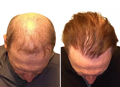 Hair Loss Patient 15 Hair Loss Patient 15