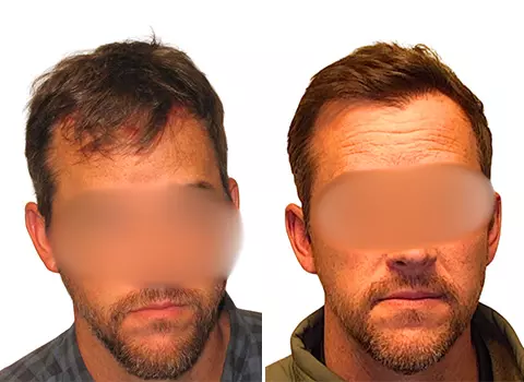 Hair Loss Patient 16 Hair Loss Patient 16