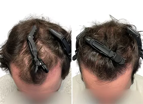 Hair Loss Patient 17 Hair Loss Patient 17
