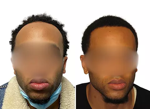 Hair Loss Patient 18 Hair Loss Patient 18