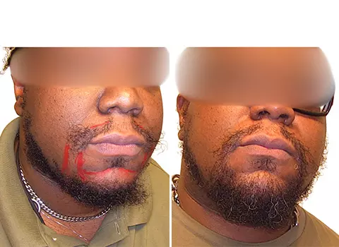 Hair Loss Patient 19 Hair Loss Patient 19