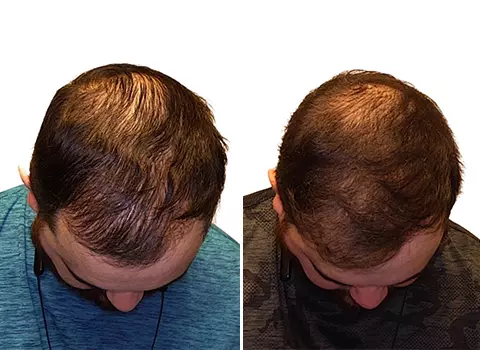 Hair Loss Patient 20 Hair Loss Patient 20